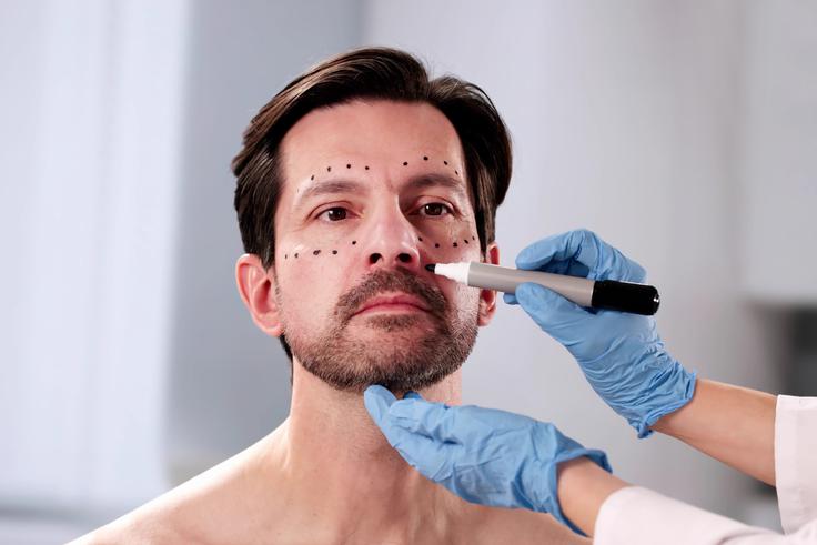 moški facelift, dvig obraza | Foto: Shutterstock