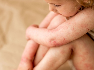 Bolečina, sram in izčrpanost: resničnost bolnikov z atopijskim dermatitisom