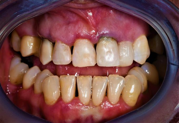 Stanje zob pred zdravljenjem | Foto: Dental Solman