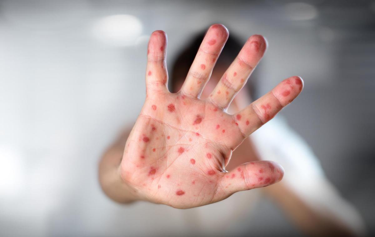 ošpice | Več kot tretjina vseh primerov na svetu prihaja iz širše evropske regije, kjer se je število okužb z ošpicami lani potrojilo na 82.596 primerov. | Foto Reuters