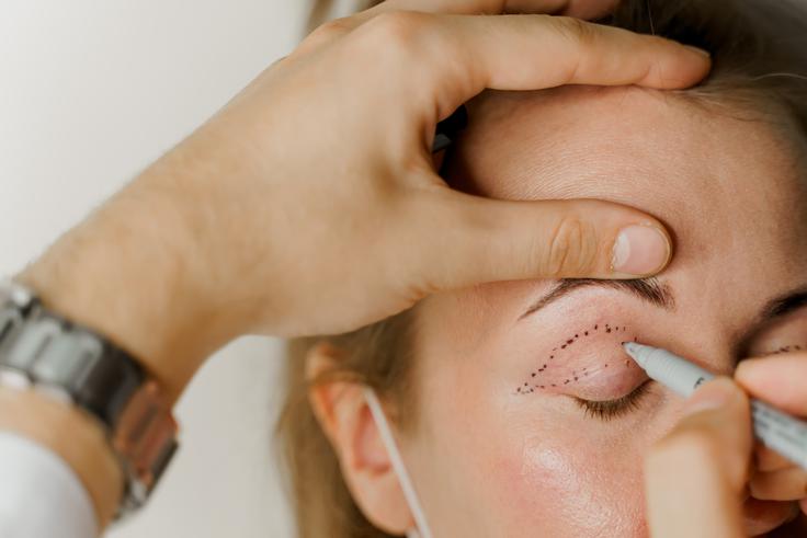 blefaroplastika | Foto: Shutterstock