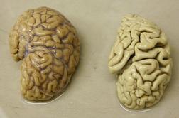Možganski spodbujevalniki rešitev za alzheimerjevo bolezen?