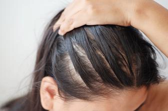 To so najpogostejše napake pri negi mastnega lasišča