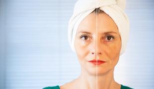 Zakaj je ta pomlajevalni tretma tako navdušil Slovence?