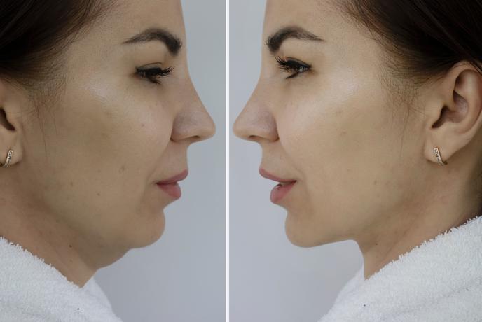 Čudežni dvig obraza? Kaj morate vedeti o posegu, ki je tudi pri nas velik hit.