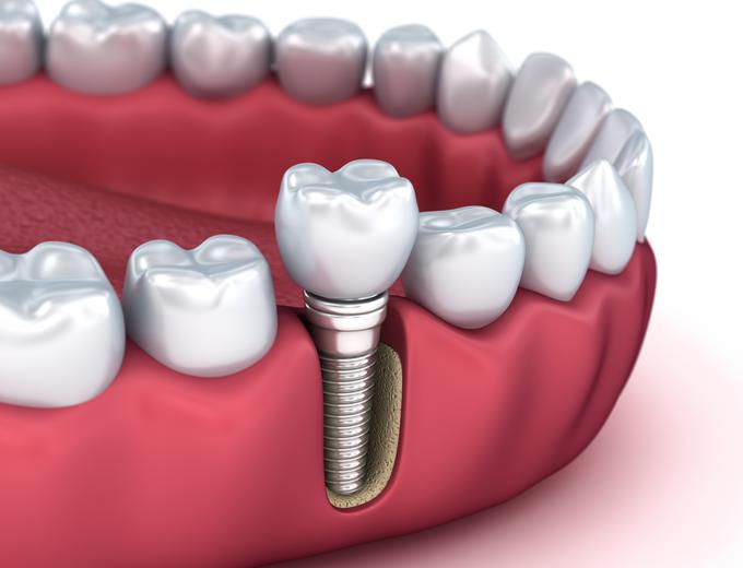 ZZZS bo zobne vsadke kril v težjih primerih, od prirojenih nepravilnosti do nepravilnosti čeljustnih kosti po odstranitvi tumorjev. | Foto: Reuters