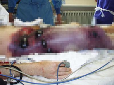 V Ukrajini se širi grozljiva bolezen: "Tega ni videl še noben živ zdravnik"