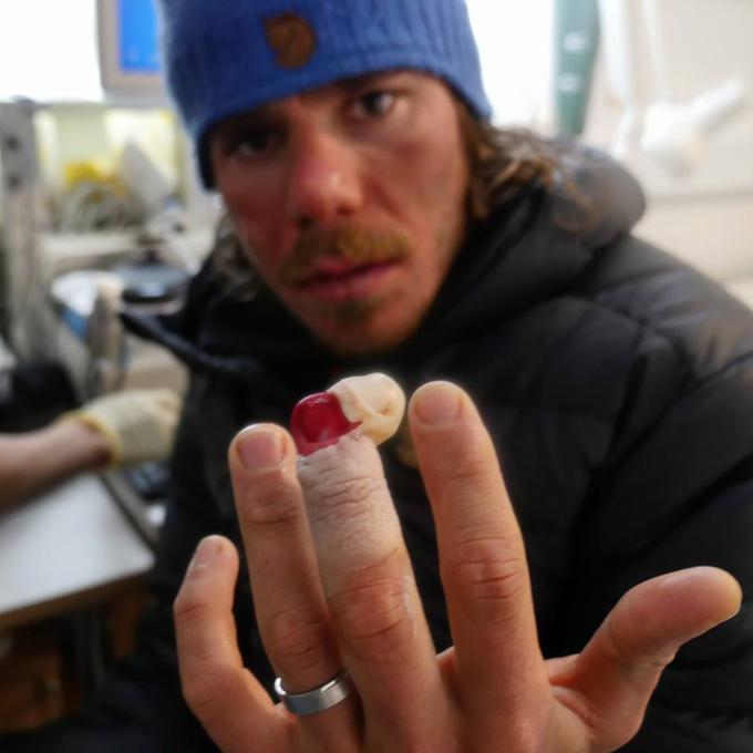 Pretresljiva fotografija posledic ozeblin. Podgornikov prst je zdaj nekaj milimetrov krajši in zelo občutljiv na dotik in bolečino. | Foto: Miha Podgornik/Facebook