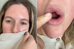 Ali pitje s slamico res deformira ustnice? Naš estetski kirurg svari, da je težava veliko večja.