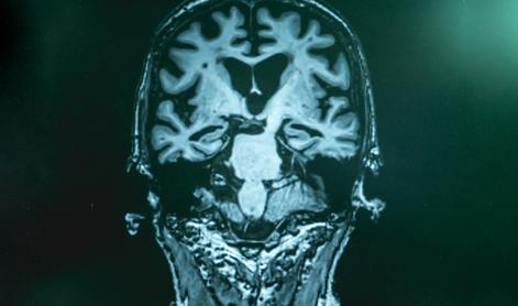 Novo upanje za bolnike z Alzheimerjevo boleznijo?