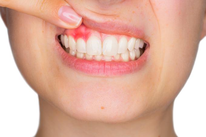 S težavami v ustni votlini se spopada več kot 90 odstotkov ljudi. | Foto: 