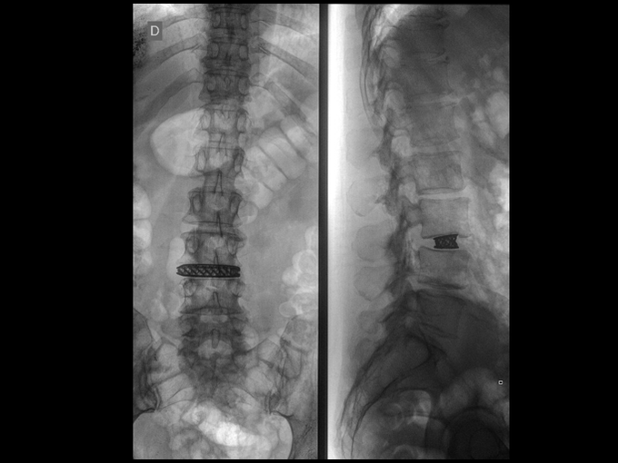 Rentgenski posnetek ledvene hrbtenice po operaciji | Foto: Lovro Suhodolčan