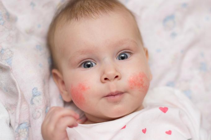 dojenček, ekcem, izpuščaj | Foto: Shutterstock