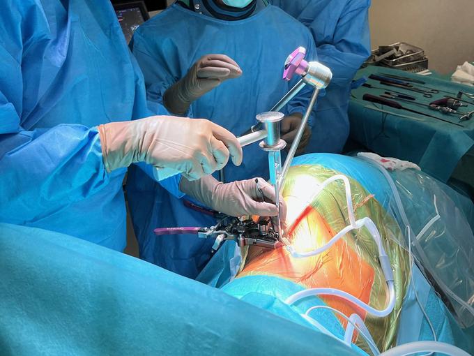 Pristop v medvretenčno ploščico med operacijo po metodi XLIF | Foto: Lovro Suhodolčan