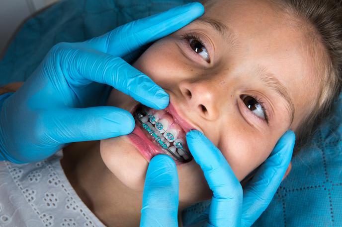 Ortodont. Zobozdravnik. Zobni aparat. | Nekateri otroci zdaj na ortodontski pregled čakajo tudi do sedem let, ortodonti pa opažajo, da je kar tretjina otrok z napotnico na ortodontski pregled tja napotena po nepotrebnem, na željo staršev. | Foto Getty Images