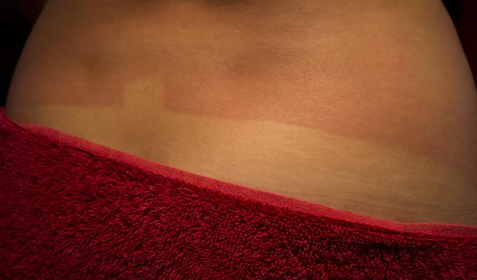 Svojo kožo zaščitite pred soncem in ne pozabite - opeče vas lahko tudi na oblačen dan. | Foto: Thinkstock