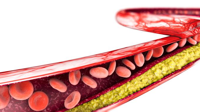 Ko je v telesu preveč slabega (LDL) holesterola, se ta kopiči na stenah žil in preprečuje normalno oskrbo celic s kisikom. | Foto: Sanofarm