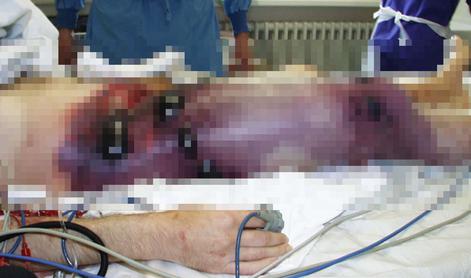 V Ukrajini se širi grozljiva bolezen: "Tega ni videl še noben živ zdravnik"