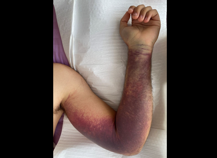 Roka po ugrizu modrasa.  | Foto: Center za klinično toksikologijo in farmakologijo