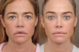 Denise Richards razkrila fotografije pred in po liftingu obraza