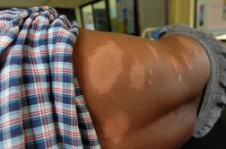 Na Hrvaškem po več desetletjih potrdili primer gobavosti