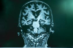 Novo upanje za bolnike z Alzheimerjevo boleznijo?