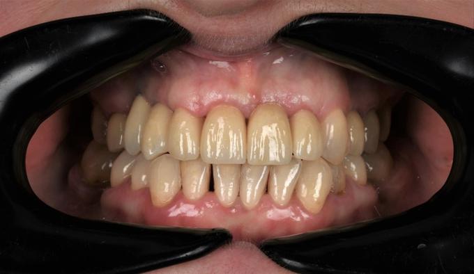 Primer oskrbe parodontalno prizadetega pacienta. | Foto: Dental Solman