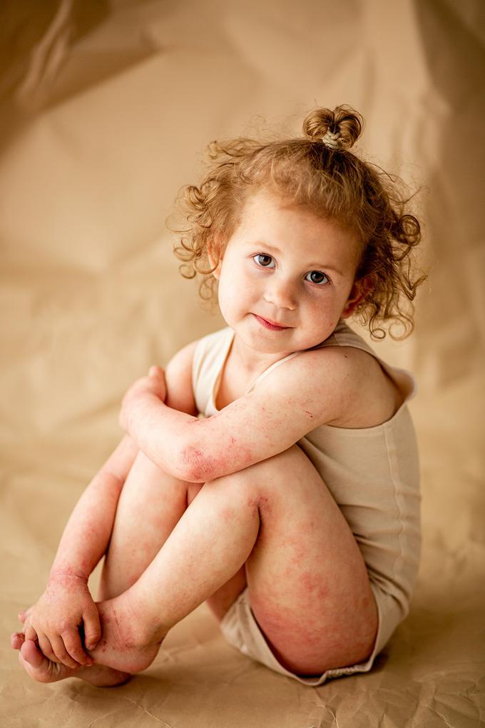 Atopijski dermatitis prizadene do 30 odstotkov otrok in do deset odstotkov odraslih. | Foto: Ines Krivec