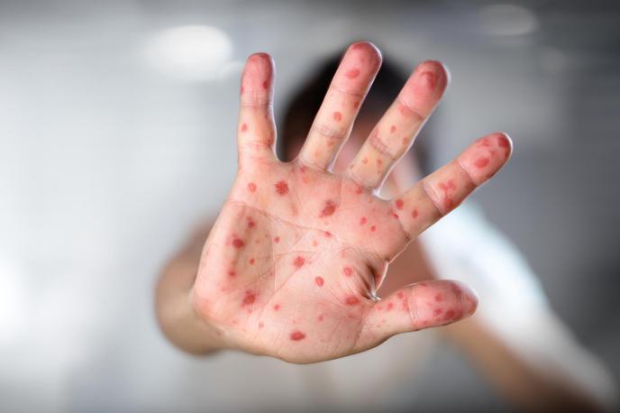 ošpice | Več kot tretjina vseh primerov na svetu prihaja iz širše evropske regije, kjer se je število okužb z ošpicami lani potrojilo na 82.596 primerov. | Foto Reuters