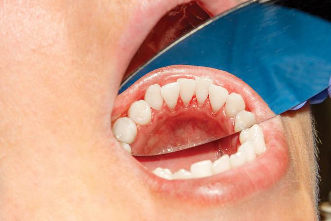 Razlika po mesecu dni redne uporabe zobne paste Bio2You je očitna. | Foto: 