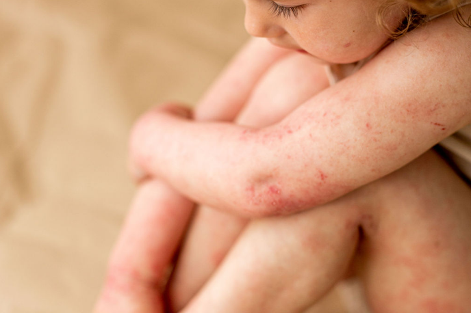 Atopijski dermatitis | Otrok z izrazitimi simptomi atopijskega dermatitisa – boleznijo, ki močno vpliva na kakovost življenja najmlajših in njihovih družin. | Foto INES IMAGES