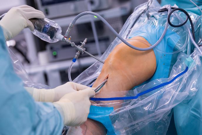 Artroskopska operacija kolena | Foto Guliverimage