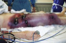 V Ukrajini se širi grozljiva bolezen: "Tega ni videl še noben živ zdravnik"