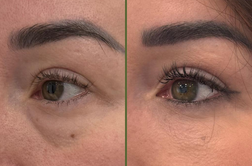 Kako lahko napačen lepotni poseg poslabša videz?