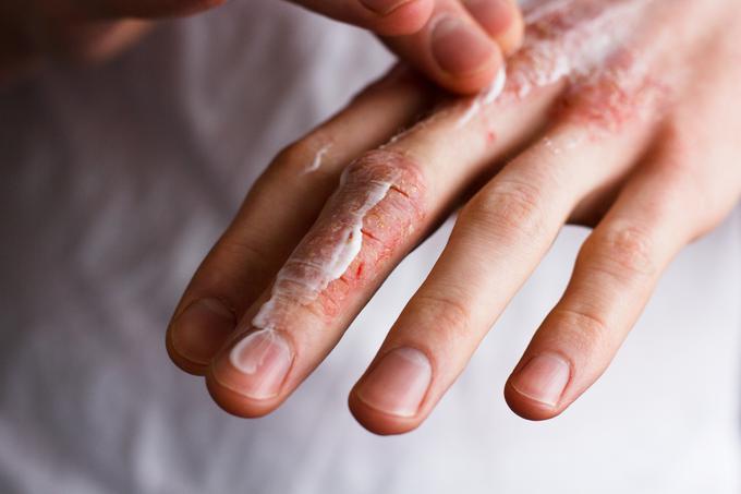 roke, suha koža, razpokana koža | Foto: Shutterstock