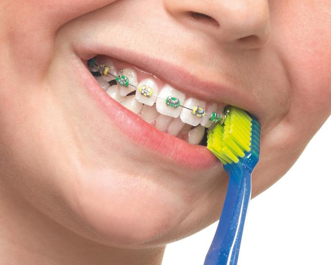 Za ščetkanje roba med zobmi in dlesnijo izberemo mehko in gosto zobno ščetko, pol ščetin položimo na dlesni, pol pa na zobe, nad nosilce aparata, in ščetkamo z malimi krožnimi gibi. Za ščetkanje zob in nosilcev posežemo po ščetki, ki ima na sredini ščetin utor – krajše prirezane ščetine.  | Foto: Curaprox