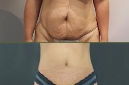 Kakšna bi morala biti realna pričakovanja po operaciji trebuha?