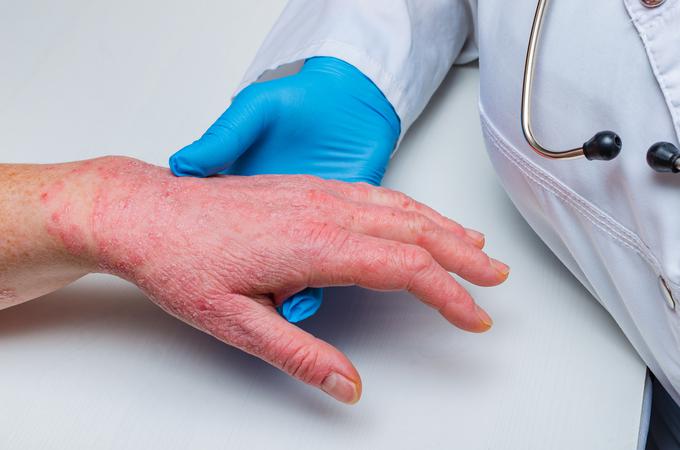 Atopijski dermatitis je bolezen, ki najbolj vidno prizadene kožo. Koža je suha, rdeča, posejana z izpuščaji in ranami, v najhujših primerih ima bolnik odprte rane po vsem telesu. | Foto: Getty Images