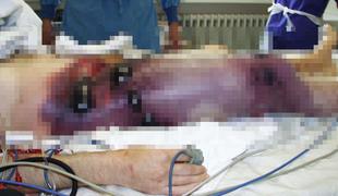 V Ukrajini se širi grozljiva bolezen: "Tega ni videl še noben živ zdravnik"