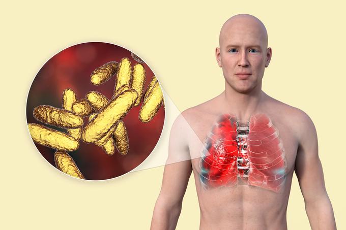 Klebsiella pneumoniae je najpomembnejši povzročitelj bolnišničnih okužb iz rodu Klebsiella. Pri bolniku povzroča pljučnico, okužbe sečil in krvnega obtoka.  | Foto: Shutterstock