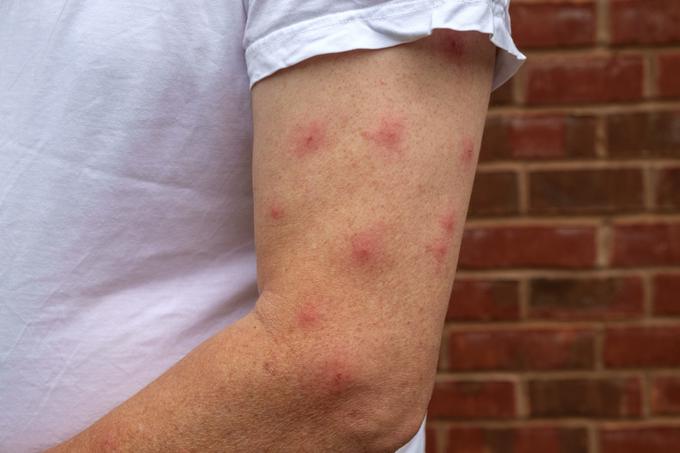 Ob piku komarja velja, da se čim manj praskamo, saj to povečuje vnetje. Če rana zakrvavi, pa je možna celo okužba. | Foto: Getty Images