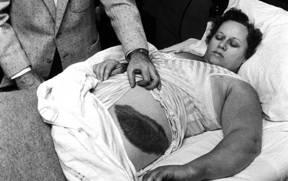 Ann Hodges | Ann Hodges 30. novembra 1954 med zdravniškim pregledom. Zaradi udarca meteorita je imela na boku veliko modrico.  | Foto Getty Images
