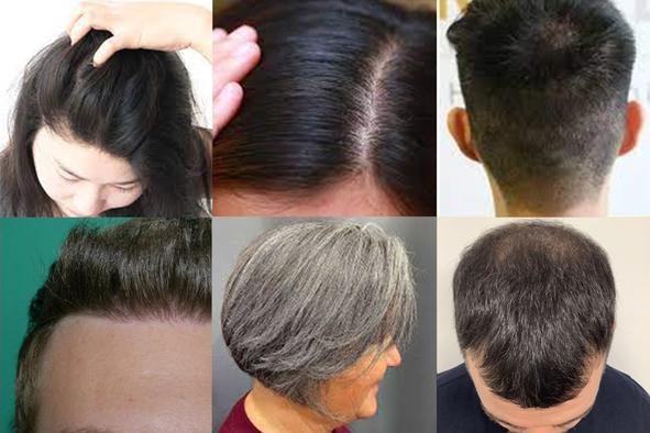 Najnovejša metoda, ki obljublja popolno obnovitev las