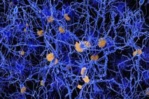 nevroni, Alzheimerjeva bolezen