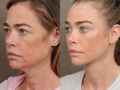 Denise Richards razkrila fotografije pred in po liftingu obraza