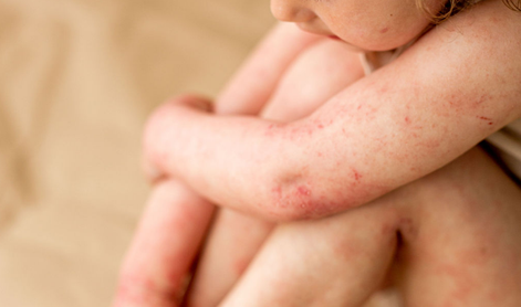 Bolečina, sram in izčrpanost: resničnost bolnikov z atopijskim dermatitisom
