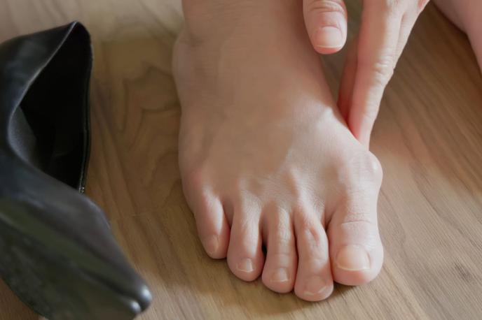 Medicofit, Hallux valgus | Foto Medicofit