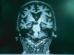 Možgani, Alzheimerjeva bolezen