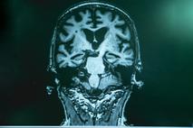 Možgani, Alzheimerjeva bolezen