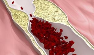 Kako s prehrano zmanjšati raven holesterola v krvi?